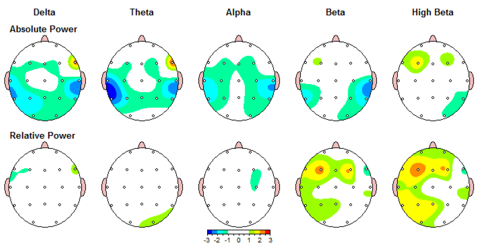 Qeeg